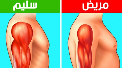 ما هو مرض ضمور العضلات .. أزمة الأدوية والأسباب ومراحل العلاج