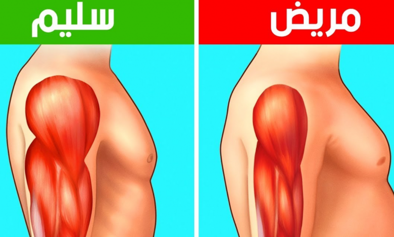 ما هو مرض ضمور العضلات .. أزمة الأدوية والأسباب ومراحل العلاج